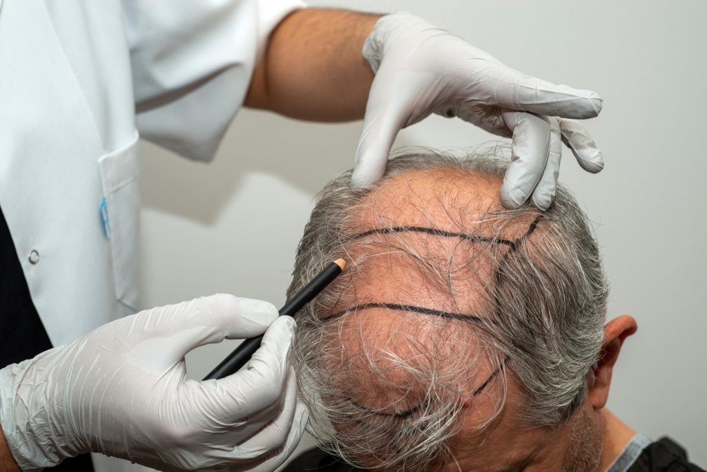 hair transplant turkey cost